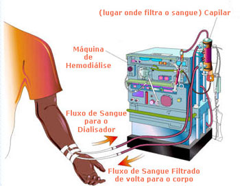 A diálise é um processo artificial que substitui as funções dos rins. É utilizado quando o paciente apresenta insuficiência renal grave.