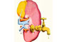 Desafios da saúde: insuficiência renal crônica