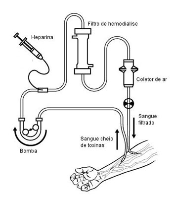 A hemodiálise é um dos maiores avanços da medicina.